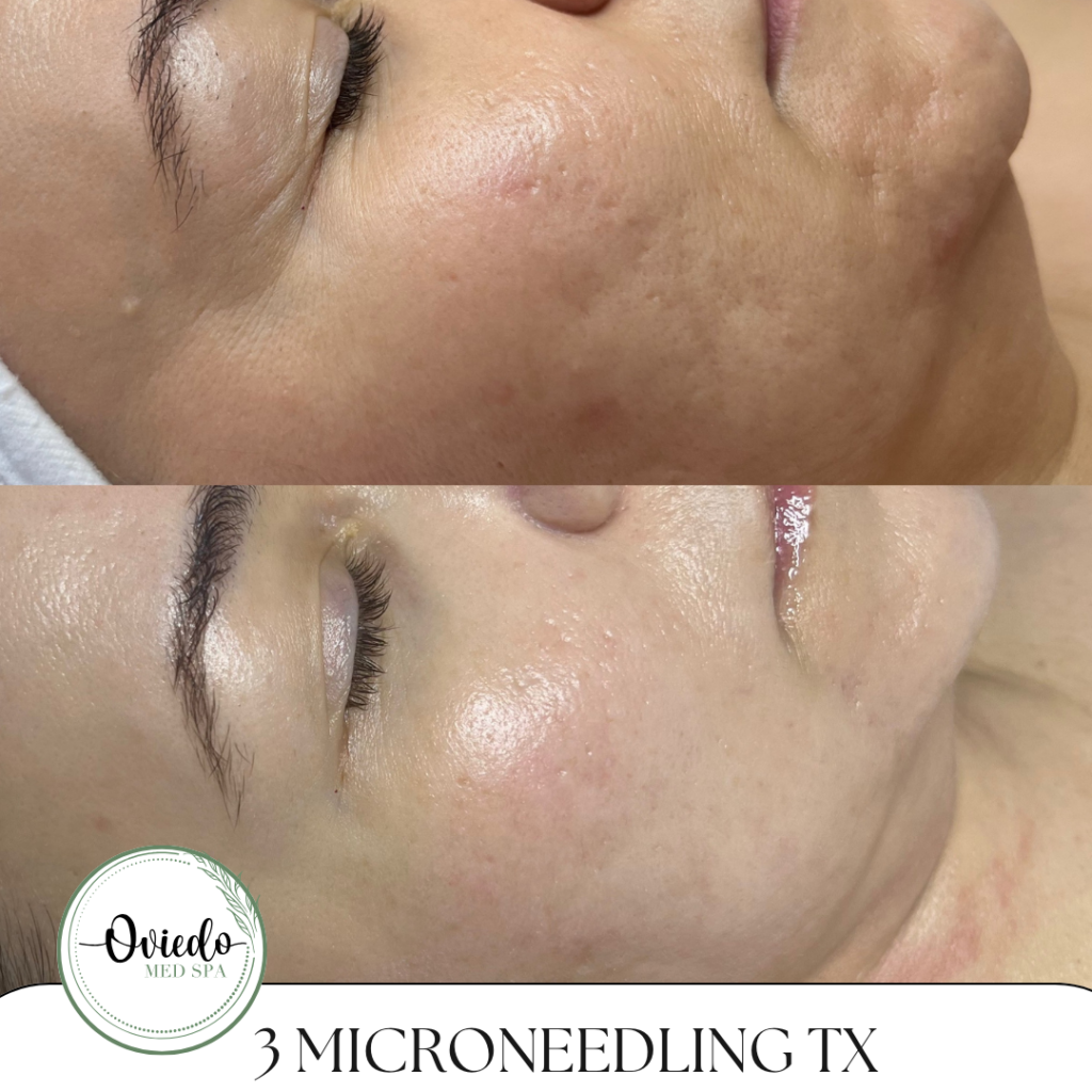 Before and after microneedling