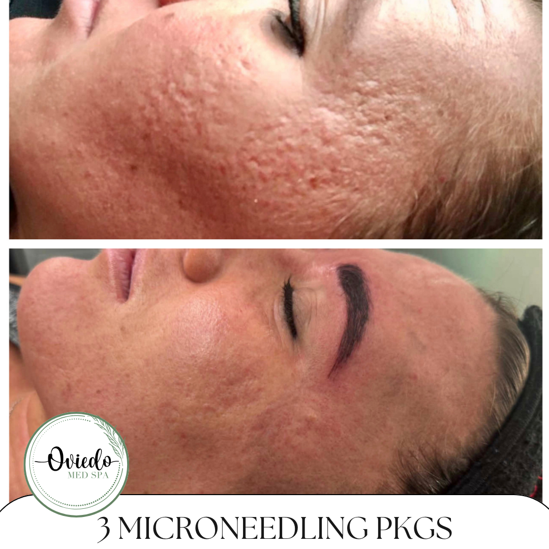 Dramatic microneedling before and after photo