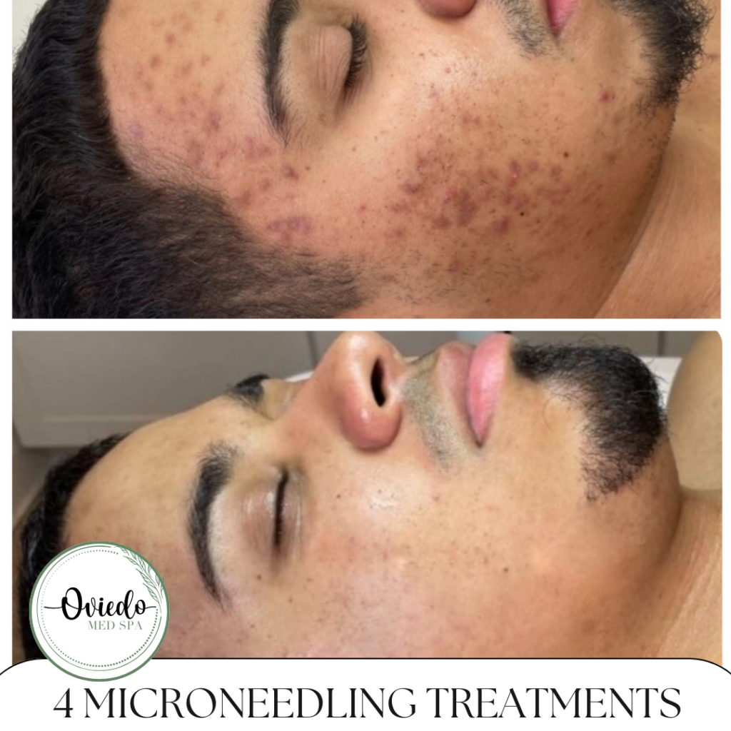 microneedling before and after photo