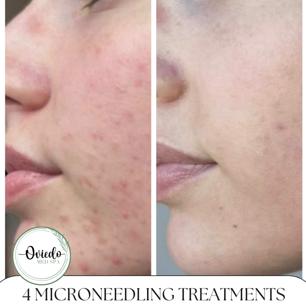 microneedling before and after