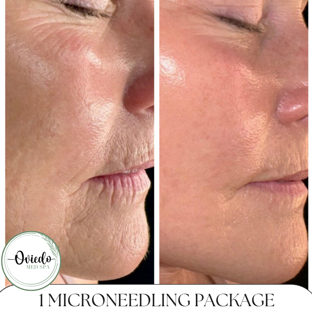 before and after of microneedling treatment
